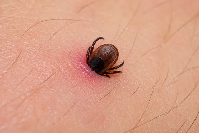 Blacklegged tick embedded in human skin with redness around the bite site